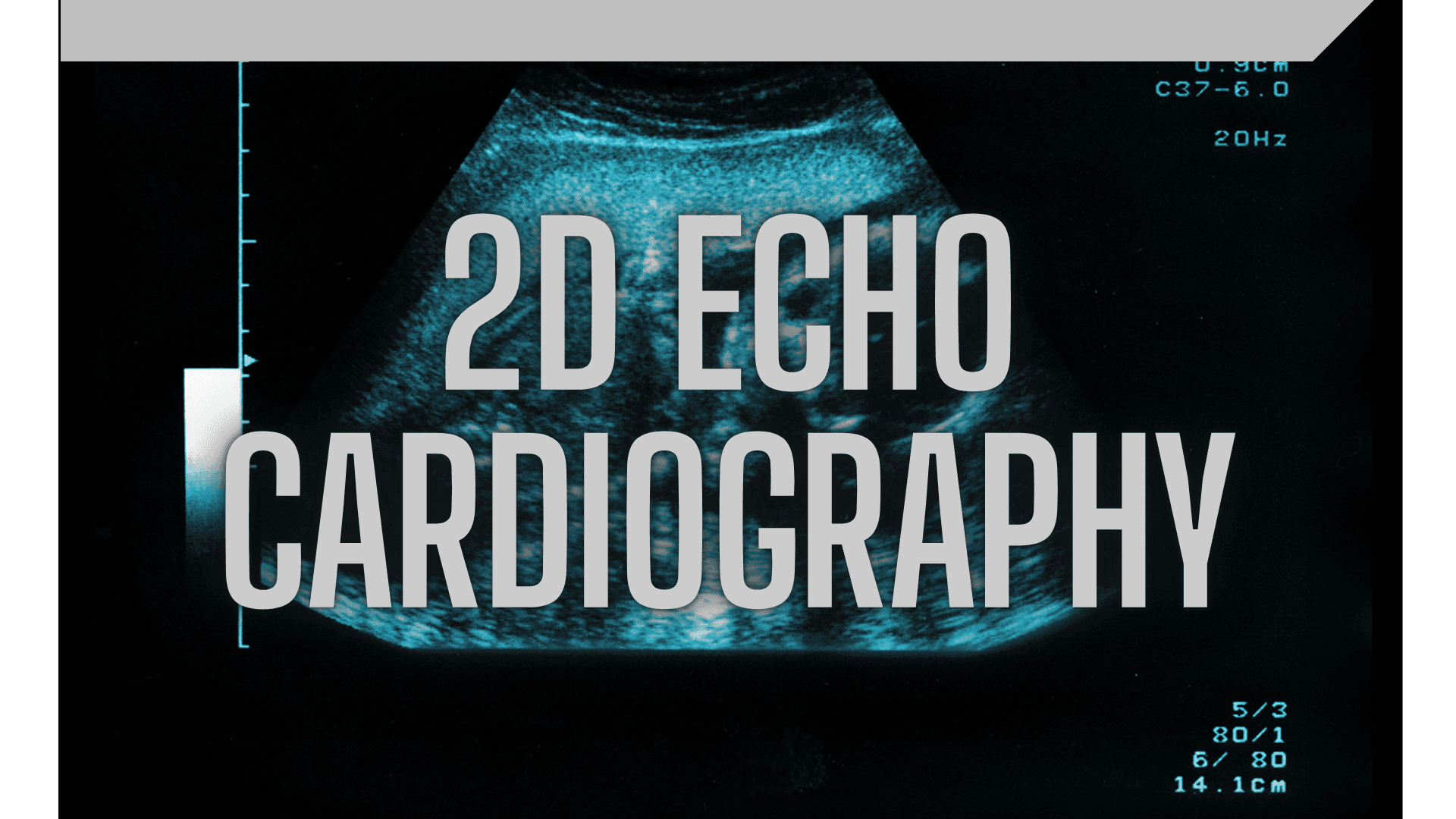 2D Echo Cardiography